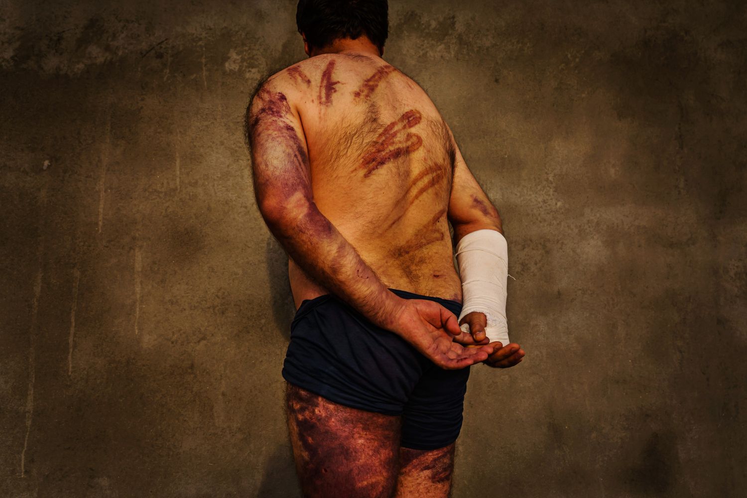 A man undressed shows the bruises on his back and legs, with a cast on his arm.