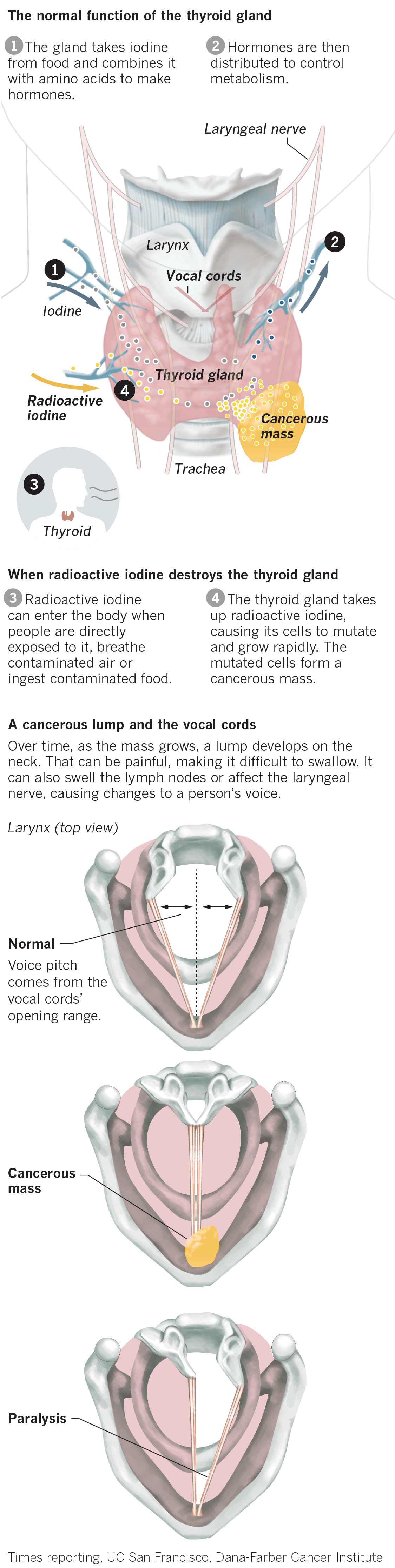 graphic showing radiation affects the thyroid